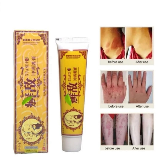 تصویر  پماد درمان پسوریازیس و اگزوما