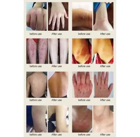 تصویر  پماد درمان پسوریازیس و اگزوما